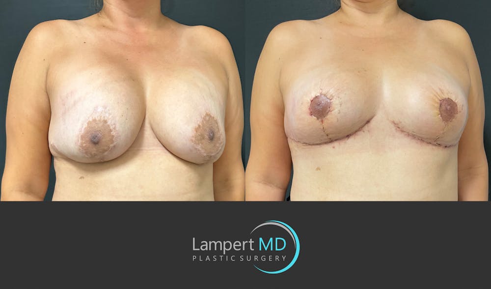 Breast Explant Before & After Gallery - Patient 382083 - Image 3