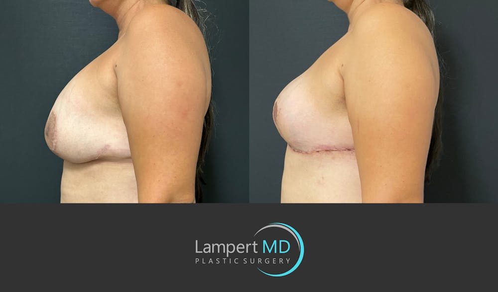 Breast Explant Before & After Gallery - Patient 382083 - Image 4