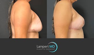 Breast Explant Before & After Gallery - Patient 382083 - Image 5