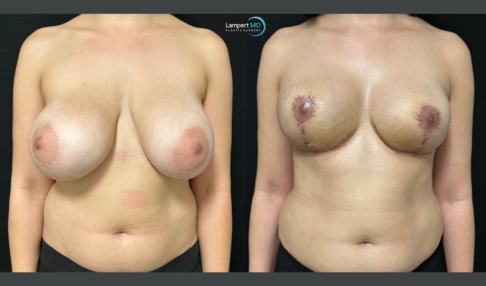 Breast Explant Before & After Gallery - Patient 193117 - Image 1