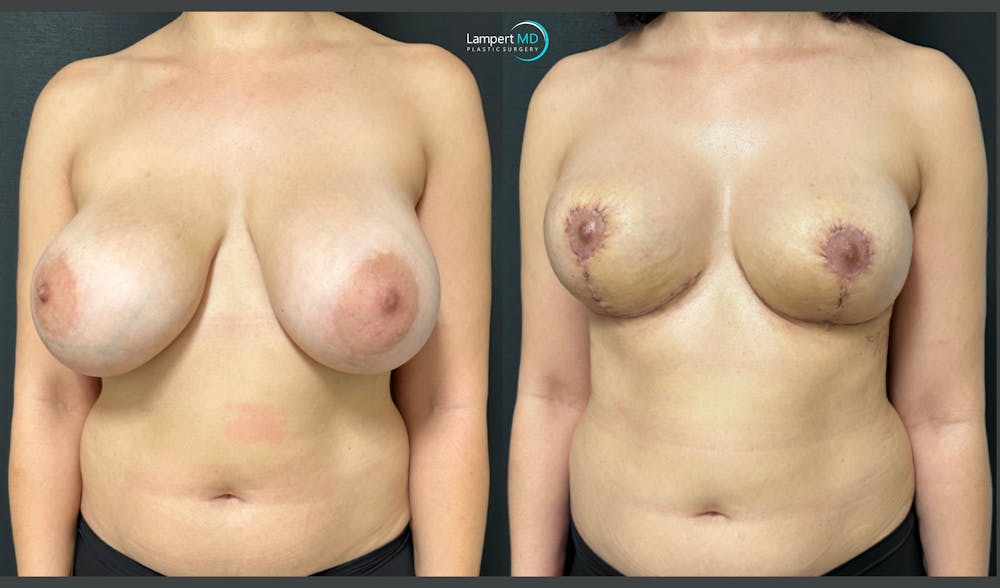 Breast Explant Before & After Gallery - Patient 193117 - Image 2
