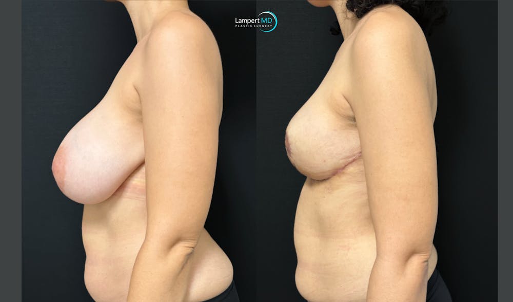 Breast Explant Before & After Gallery - Patient 193117 - Image 4