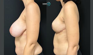 Breast Explant Before & After Gallery - Patient 193117 - Image 4