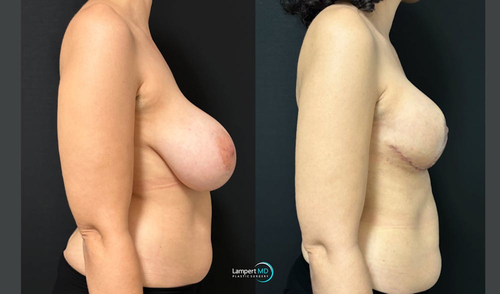 Breast Explant Before & After Gallery - Patient 193117 - Image 5