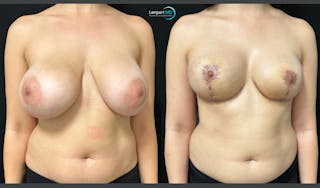 Breast Explant Before & After Gallery - Patient 193117 - Image 3