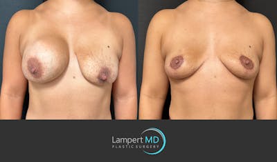 Breast Explant Before & After Gallery - Patient 335153 - Image 1