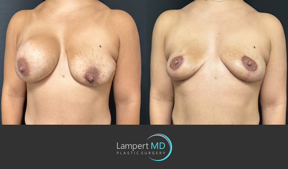 Breast Explant Before & After Gallery - Patient 335153 - Image 2