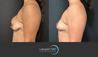 Breast Explant Before & After Gallery - Patient 335153 - Image 3