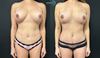 Breast Explant Before & After Gallery - Patient 132429 - Image 1
