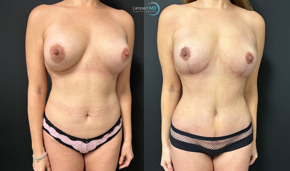 Breast Explant Before & After Gallery - Patient 132429 - Image 2