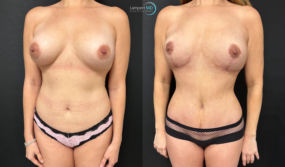 Breast Explant Before & After Gallery - Patient 132429 - Image 3