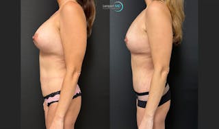 Breast Explant Before & After Gallery - Patient 132429 - Image 4