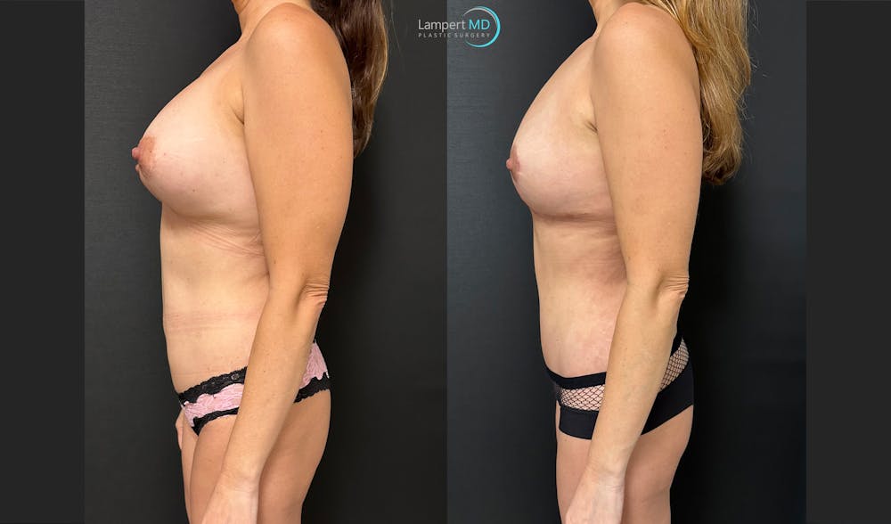 Breast Explant Before & After Gallery - Patient 132429 - Image 4