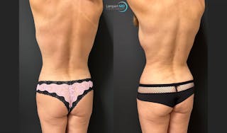 Breast Fat Transfer Before & After Gallery - Patient 333925 - Image 6