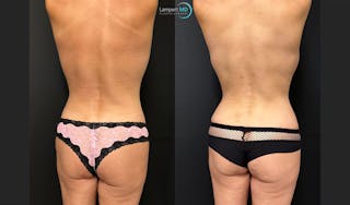 Breast Fat Transfer Before & After Gallery - Patient 333925 - Image 5