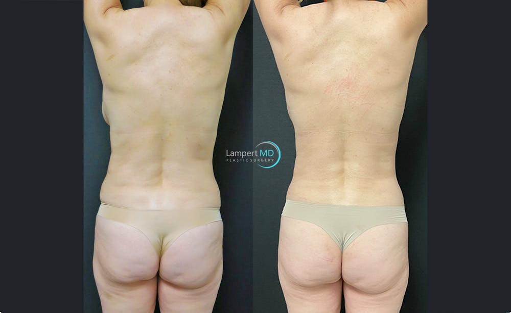 Love Handle Liposuction Before & After Gallery - Patient 376795 - Image 1