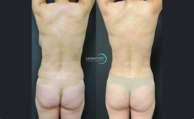 Love Handle Liposuction Before & After Gallery - Patient 376795 - Image 1