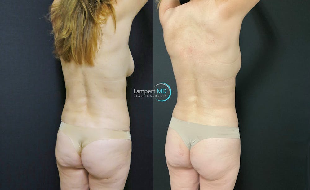 Love Handle Liposuction Before & After Gallery - Patient 376795 - Image 2