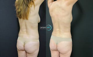 Love Handle Liposuction Before & After Gallery - Patient 376795 - Image 2