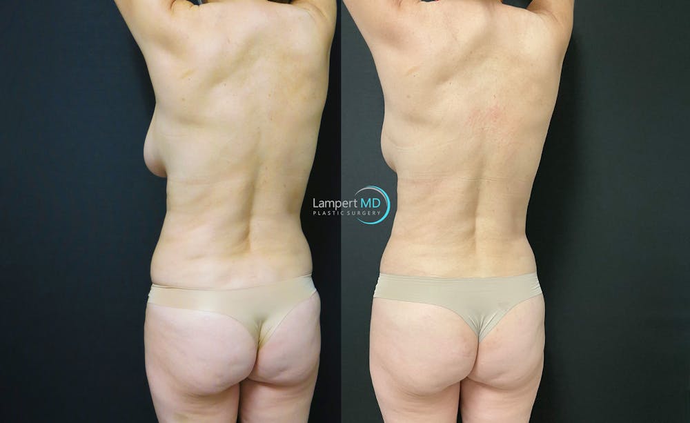 Love Handle Liposuction Before & After Gallery - Patient 376795 - Image 3