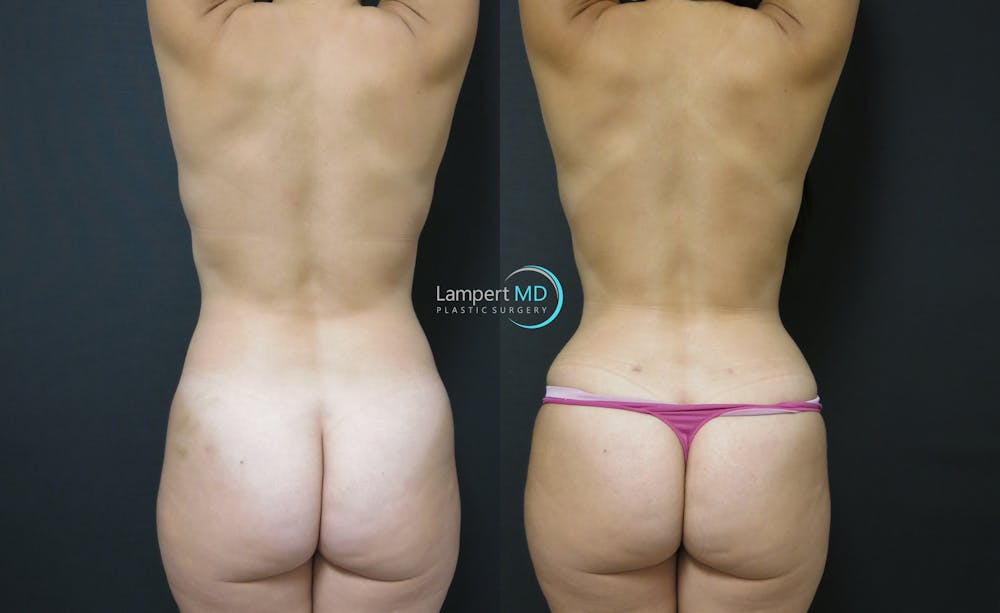 Love Handle Liposuction Before & After Gallery - Patient 104279 - Image 1
