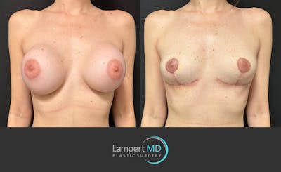 Breast Explant Before & After Gallery - Patient 859331 - Image 1