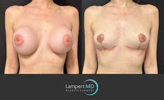 Breast Explant Before & After Gallery - Patient 859331 - Image 1