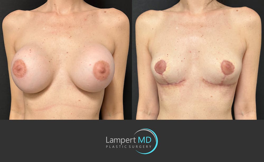 Breast Explant Before & After Gallery - Patient 859331 - Image 2