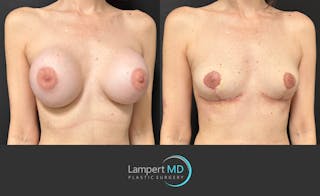 Breast Explant Before & After Gallery - Patient 859331 - Image 3