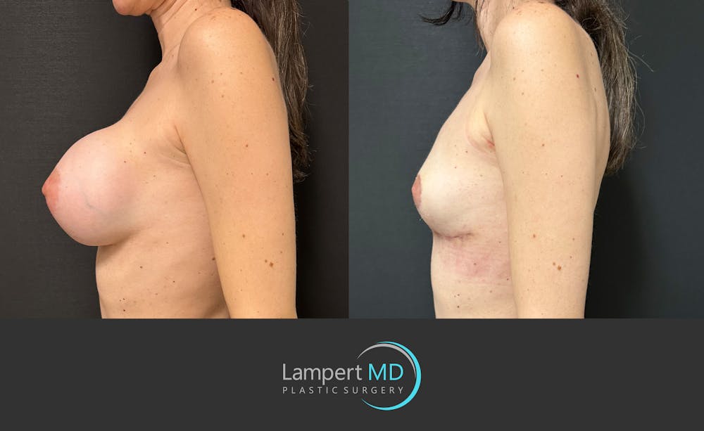 Breast Explant Before & After Gallery - Patient 859331 - Image 4