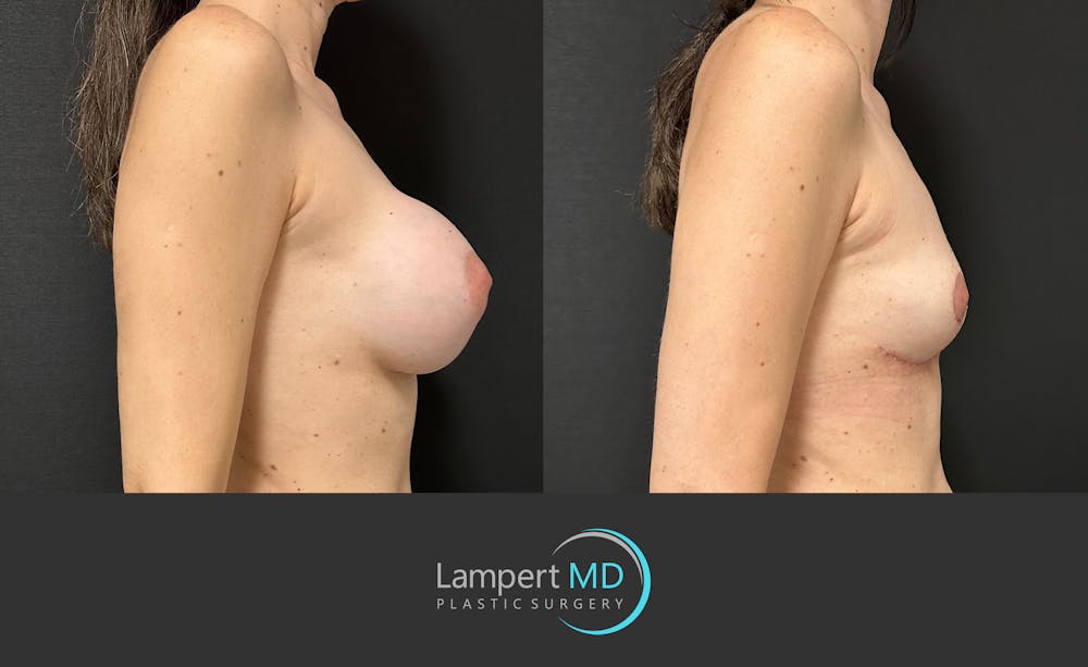 Breast Explant Before & After Gallery - Patient 859331 - Image 5