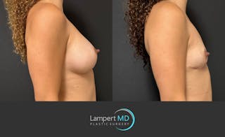 Breast Explant Before & After Gallery - Patient 116434 - Image 4