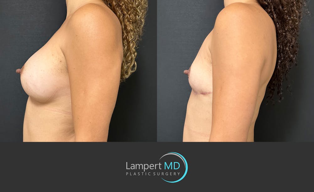 Breast Explant Before & After Gallery - Patient 116434 - Image 5