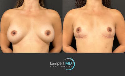 Breast Explant Before & After Gallery - Patient 116434 - Image 1
