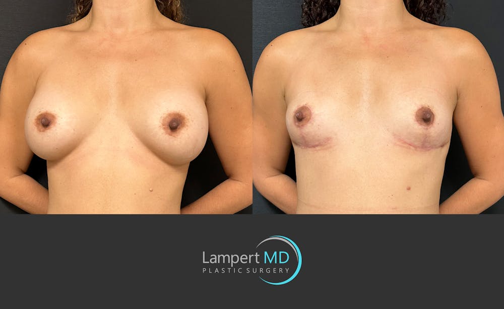 Breast Explant Before & After Gallery - Patient 116434 - Image 2