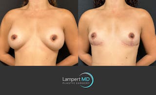 Breast Explant Before & After Gallery - Patient 116434 - Image 2