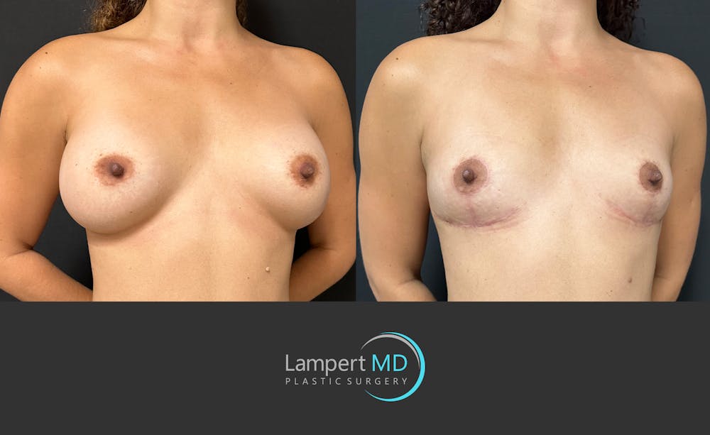 Breast Explant Before & After Gallery - Patient 116434 - Image 3