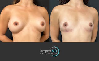 Breast Explant Before & After Gallery - Patient 116434 - Image 3