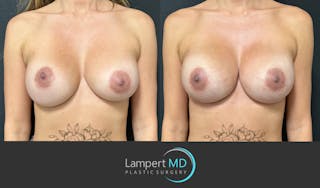 Breast Reconstruction Before & After Gallery - Patient 771126 - Image 1