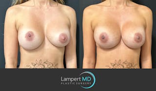 Breast Reconstruction Before & After Gallery - Patient 771126 - Image 2