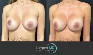 Breast Reconstruction Before & After Gallery - Patient 771126 - Image 3