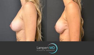 Breast Reconstruction Before & After Gallery - Patient 771126 - Image 4