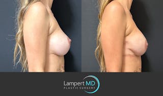 Breast Reconstruction Before & After Gallery - Patient 771126 - Image 5