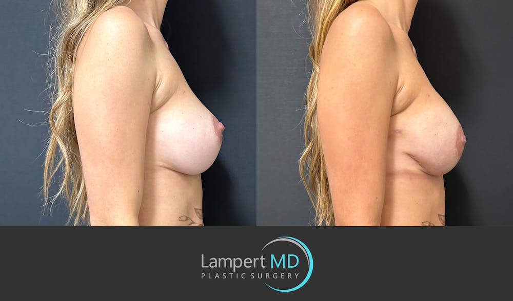 Breast Reconstruction Before & After Gallery - Patient 771126 - Image 5