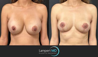 Breast Explant Before & After Gallery - Patient 356229 - Image 1