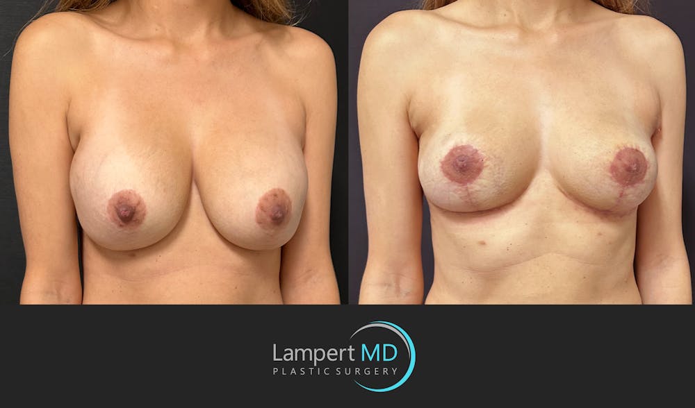 Breast Explant Before & After Gallery - Patient 356229 - Image 2