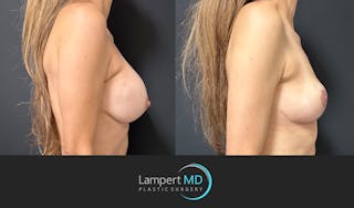 Breast Explant Before & After Gallery - Patient 356229 - Image 3