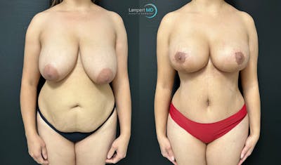 Tummy Tuck Before & After Gallery - Patient 298098 - Image 1