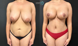 Tummy Tuck Before & After Gallery - Patient 298098 - Image 2