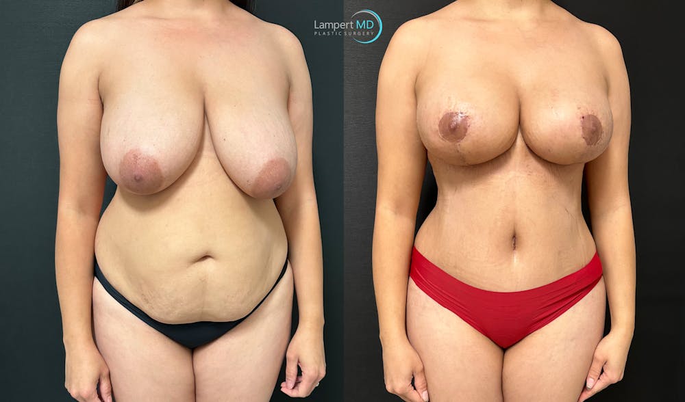 Tummy Tuck Before & After Gallery - Patient 298098 - Image 3